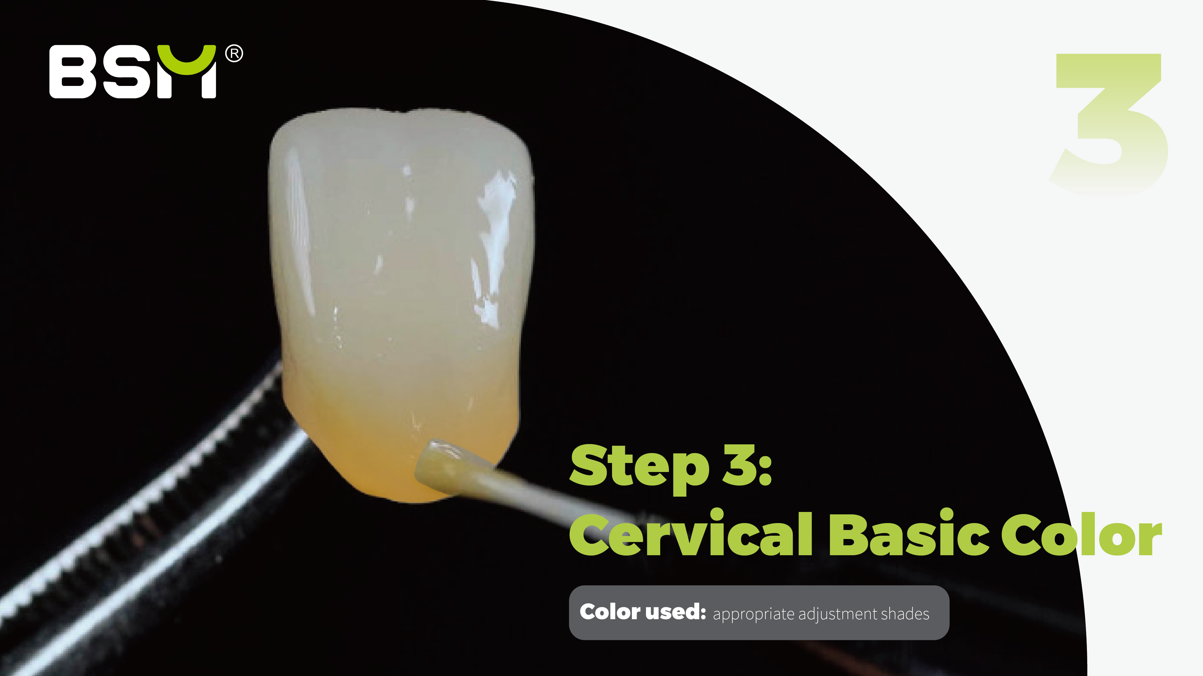 dental bonding staining