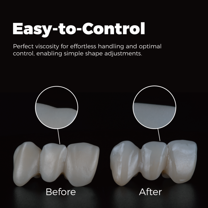 dental onlay stain