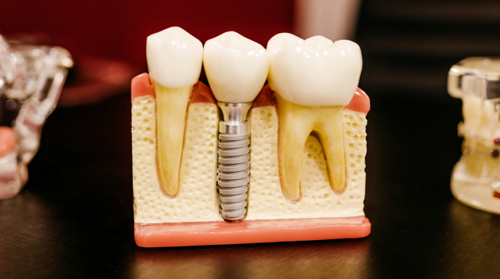 dental implants supplier